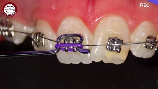 O-tie application by ortho probe , twirl-on ligature applicator