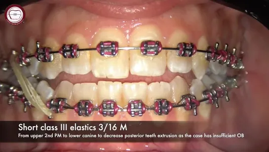 Orthodontic class III elastic step by step by Dr. Amr Asker