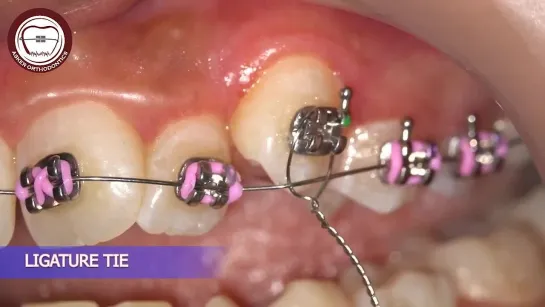 Orthodontic Canines traction by distant ligature method  by dr Amr Asker