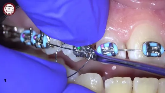 Orthodontic ligature tie for rotation correction  by Dr. Amr Asker