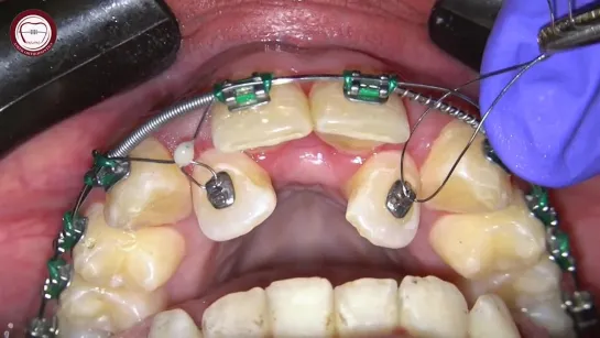 Douple wire mechanics+distant ligature traction after MARPE expansion