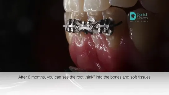 Recession - orthodontic  periodontal re-treatment  🦷