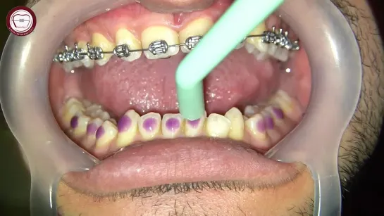 Anterior bite turbo in deep bite cases+bonding lower braces, How to raise the bite in orthodontics