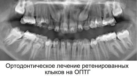 Наглядно: ортодонтическое лечение на ОПТГ. Ретенция клыков.