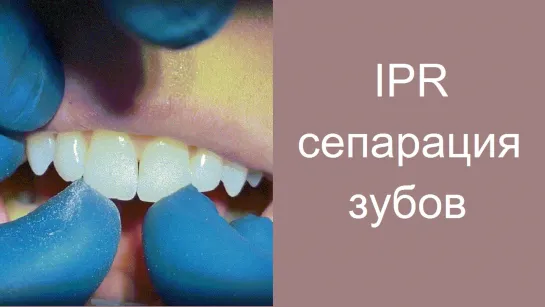 IPR. Сепарация зубов. Ортодонтия, брекеты.