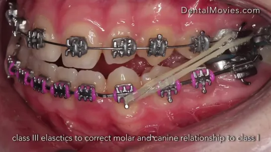 15 y. girl with open bite and crossbite - intrusion with miniscrews. Ортодонтия