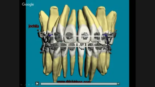 TECNICA DE ARCO RECTO DE FUERZA DIFERENCIAL CON BRACKETS TIP-EDGE PLUS. Техника прямой дуги.Ортодонтия.Брекеты.