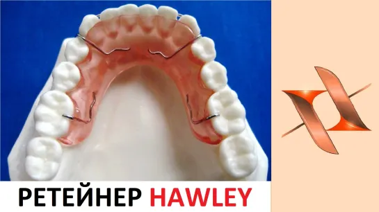 Съёмный ретейнер Hawley. Ортодонтия.