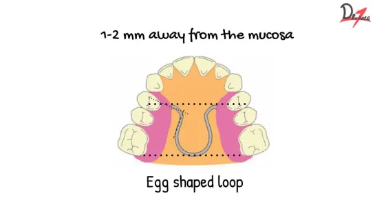 Parts of Bionator. Ортодонтия.