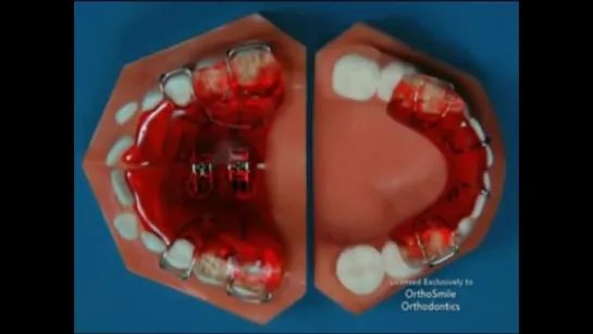 Orthosmile - Twinblock. Ортодонтия.