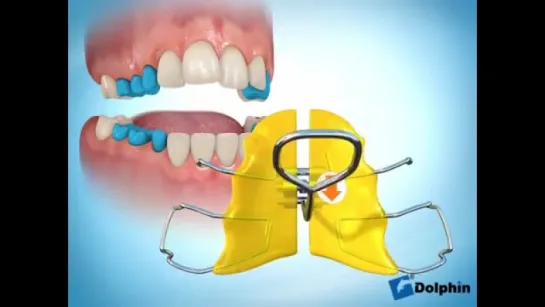 Maxillary Expander (Removable).Ортодонтия.