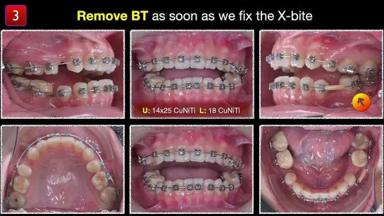 Bite Turbos：General concepts and Clinical application. Chris Chang Ortho