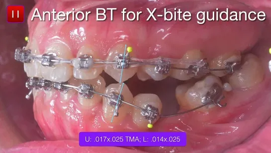 Bite Turbos：General concepts and Clinical application. Chris Chang Ortho