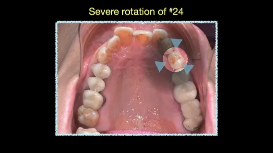 Chris Chang Ortho . Clinical Tip：De-rotation of UL4