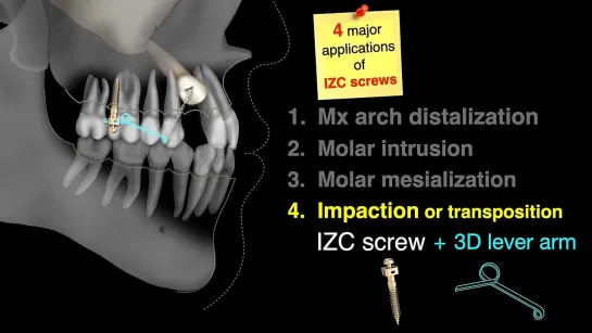 Chris Chang Ortho.  Aligner vs  Impacted U3：Two phase aligner tx