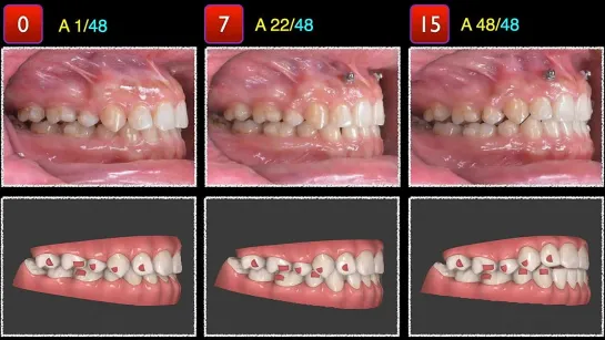 Chris Chang Ortho. Torque  deep bite