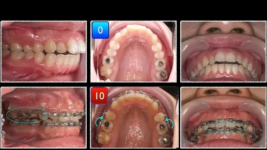 Chris Chang Orthoю Clinical Tips：Anterior torque control during space closure