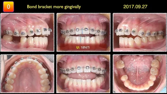 Chris Chang Ortho Case Analysis：Anterior Open Bite