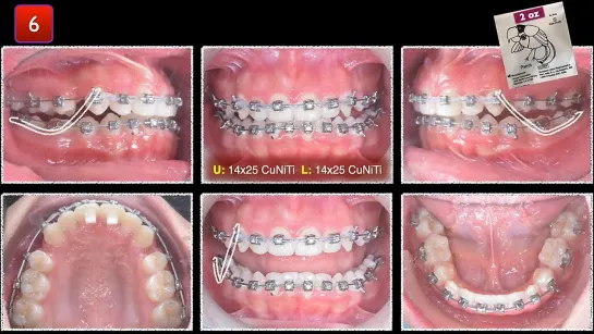 Chris Chang Ortho. Treatment of Blocked in Upper Lateral Incisors with Excessive Overjet