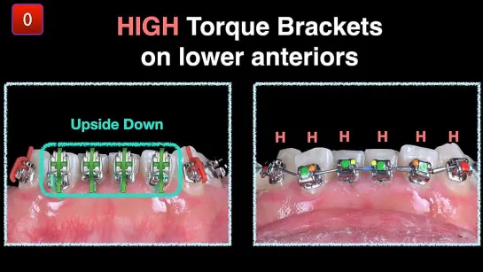 Camouflage treatment of Class III malocclusion with anterior crossbite and midline deviation