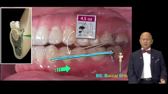 Chris Chang  TADs to correct challenging malocclusions with Clear Aligners