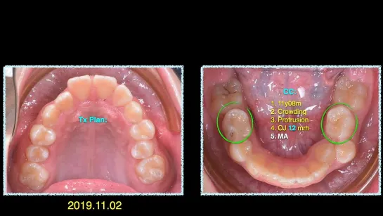 Chris Chang Ortho. Class II Mechanics for Overjet Reduction Part3