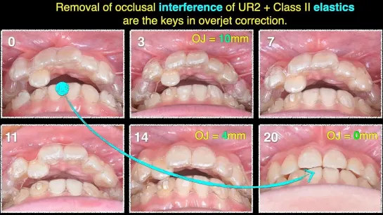 Chris Chang Ortho. Class II Mechanics for Overjet Reduction Part1