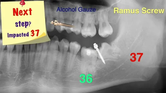 Chris Chang Ortho. Simplified Mechanics for Aligners in Treating Complex Cases Part6