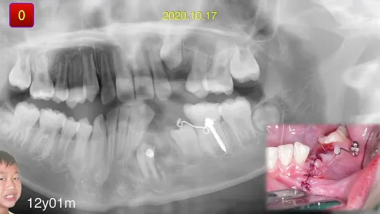 Chris Chang Ortho Simplified Mechanics for Aligners in Treating Complex Cases Part5