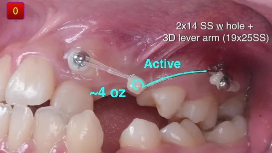 Chris Chang Ortho Simplified Mechanics for Aligners in Treating Complex Cases Part4