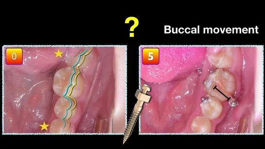 Chris Chang Ortho Simplified Mechanics for Aligners in Treating Complex Cases Part3