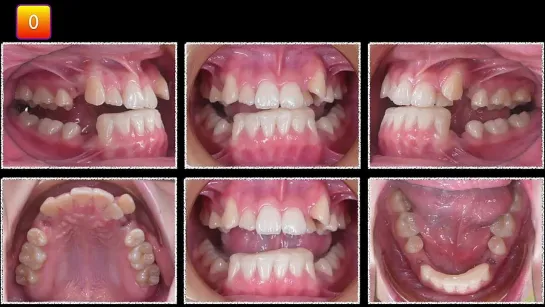 Chris Chang Ortho. Simplified Mechanics for Aligners in Treating Complex Cases Part2