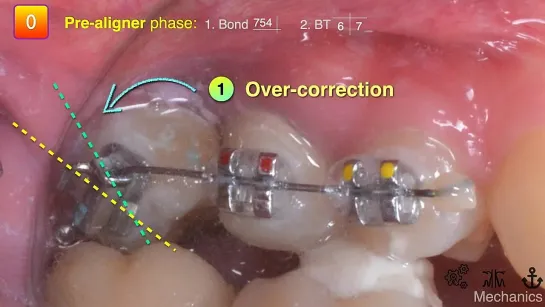 Chris Chang Ortho Aligner vs Fixed ortho.Two-phase aligner tx