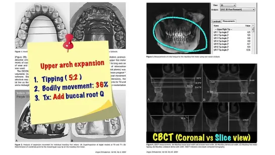 Chris Chang Ortho. Simplified Mechanics for Aligners in Treating Complex Cases Part1