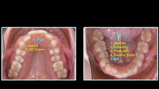 Chris Chang Ortho. CII Tx with Aligners：Mandibular Advancement in Adults Part1