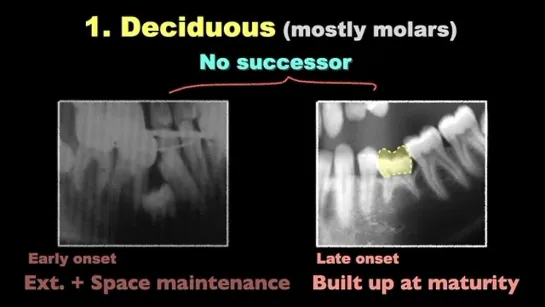 Chris Chang: Orthom Paper review.  Etiology and treatment of tooth ankylosis