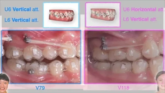 Chris Chang Ortho. 4-bi. ext.：Incisal + IZC screws