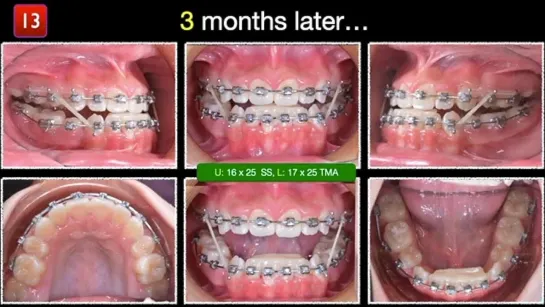 Chris Chang Ortho.Extraction Strategy for CIII - Trap of Growth