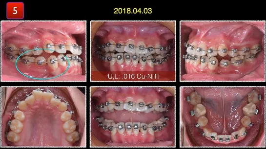 Chris Chang. ABO Case Report