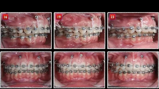 Chris Chang.   Class II, Deep Bite, Adult  Young