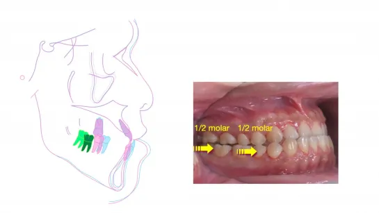 Chris Chang Ortho. Correction of Class III Malocclusion by Customized Self-Ligating System