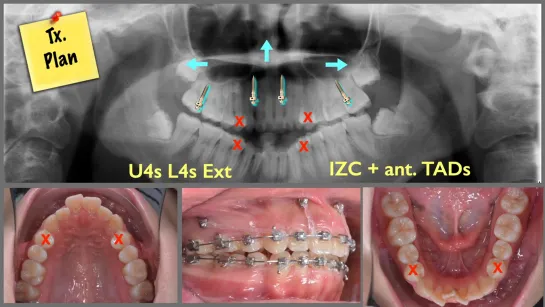 Крис Чанг. Miniscrew placement site and its impact on the treatment of Class ll malocclusion combined with ante