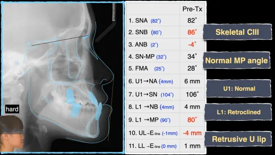 Chris Chang Ortho. Nonsurgical correction of a Class III malocclusion with miniscrews.