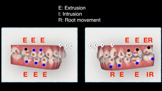 Крис Чанг.A two phase aligner treatment for dentoalveolar protrusion with severe rotation of LL7