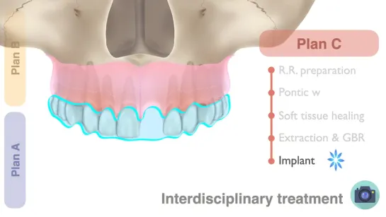 Крис Чанг.Retrospective considerations for complications in the anteriors in three interdisciplinary cases