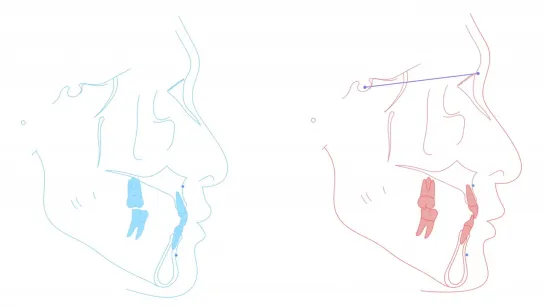 Chris Chang Ortho. Interdisciplinary Treatment for Congenital Absence of Multiple Teeth