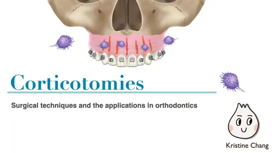 Chris Chang. Corticotomies. Surgical techniques and the applications in orthodontics. Ортодонтия