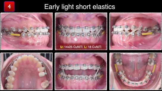 Chris Chang.  Solving Anterior Crossbite With Elastics. Ортодонтия