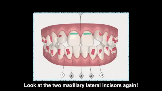 Chris Chang. Extruding Maxillary Lateral Incisors with Clear Aligners. Ортодонтия