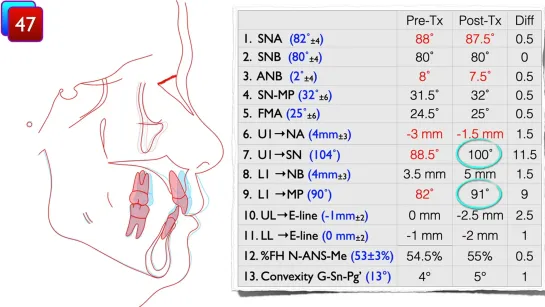 Chris Chang. A two phase aligner treatmentfor Class II malocclusion with deep bite. Ортодонтия